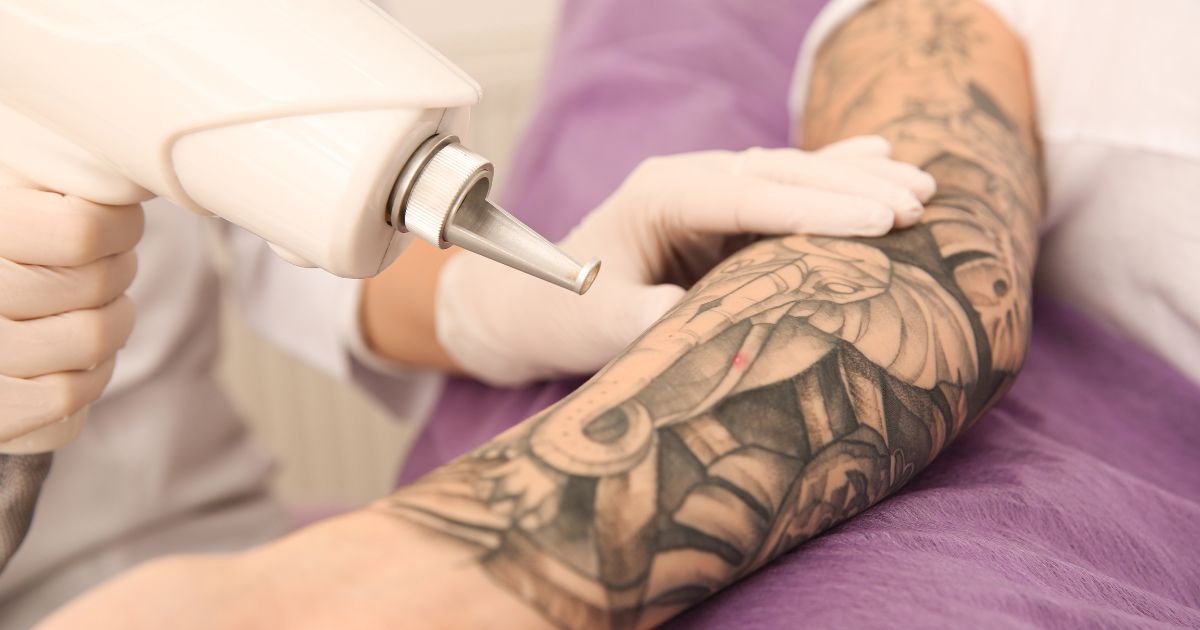 Laser-Tattoo-Removal