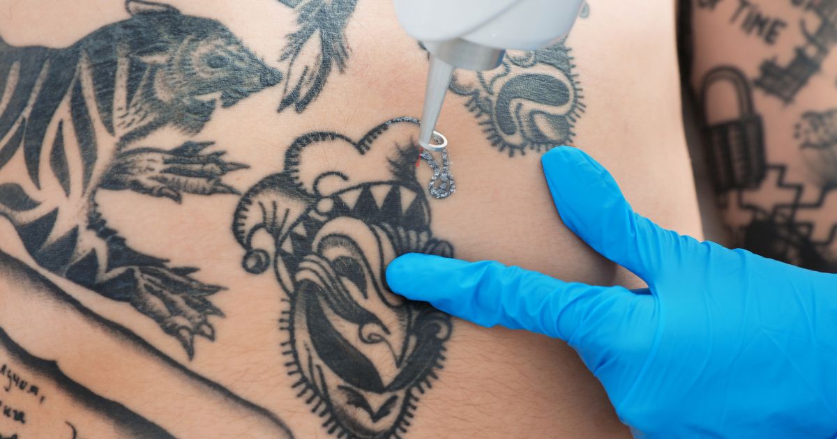 Laser-Tattoo-Removal