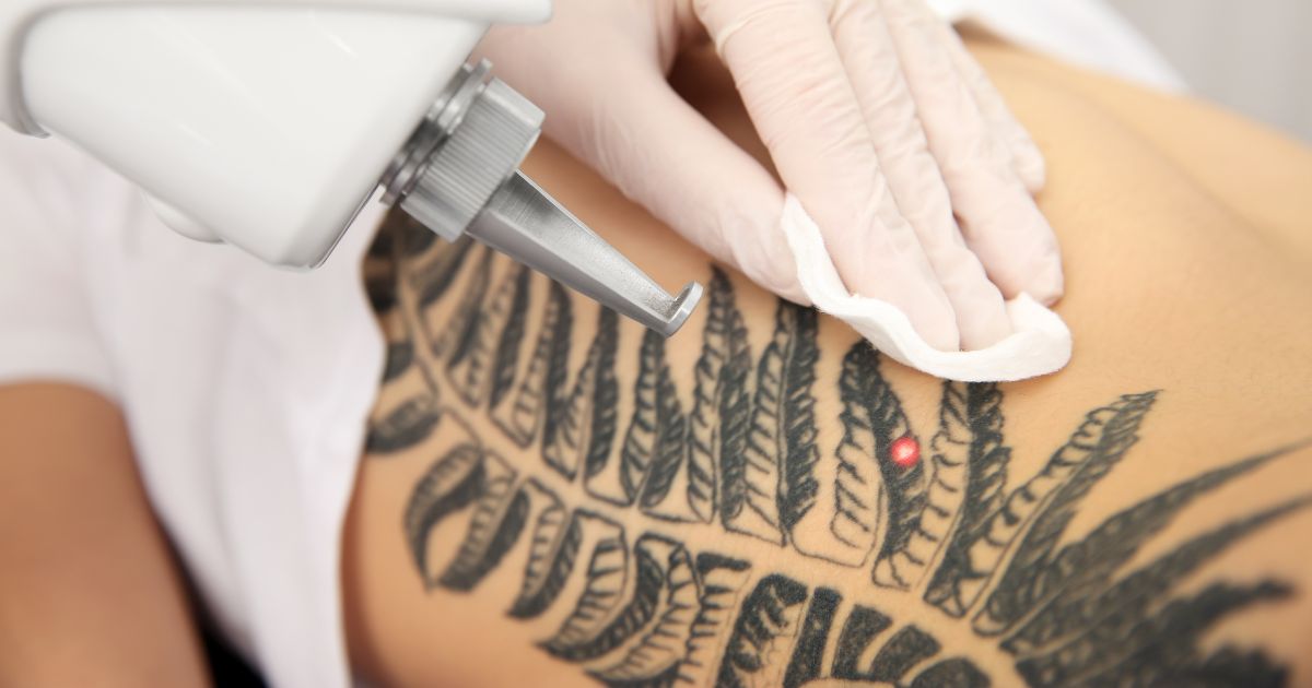 Laser-Tattoo-Removal