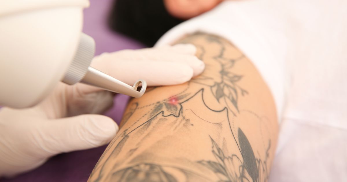 Laser-Tattoo-Removal