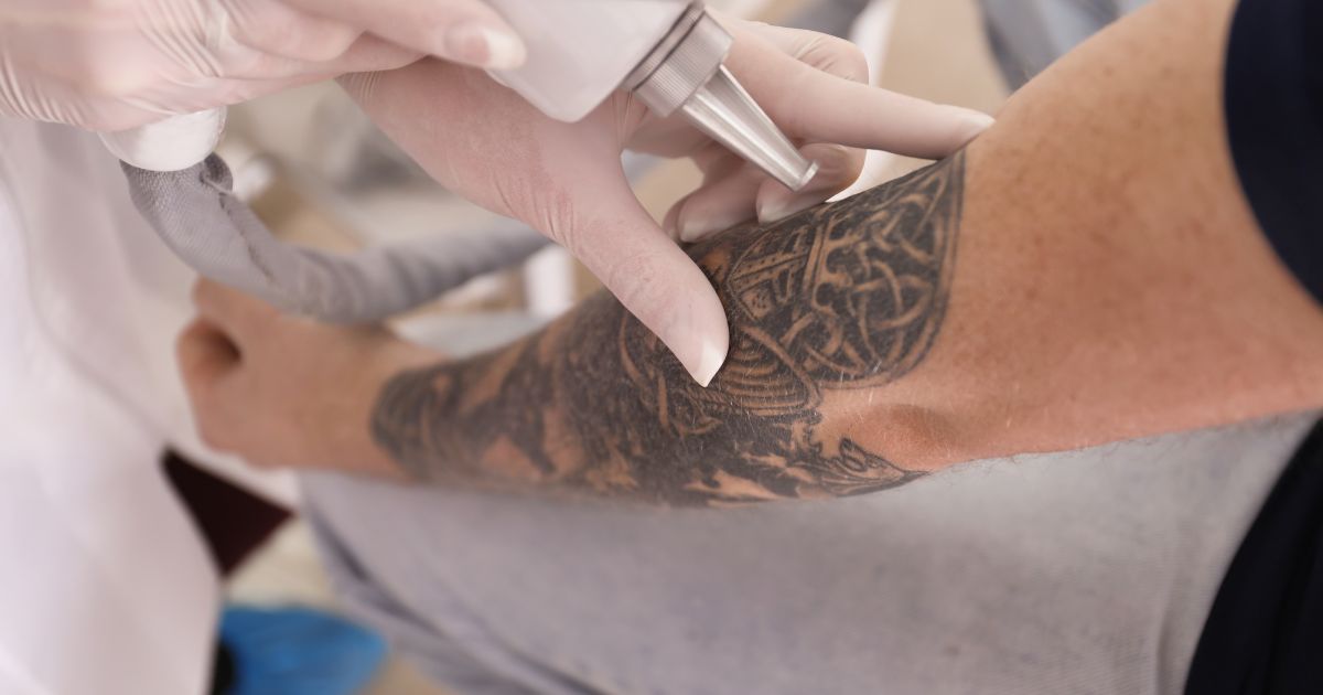 Tattoo-Removal-Near-Me