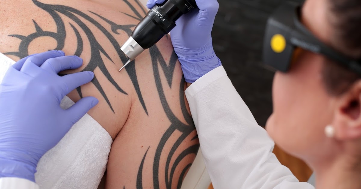 Tattoo-Removal-Near-Me