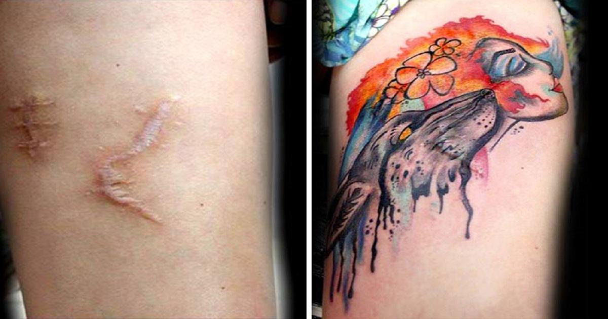 Before-and-After-of-Laser-Tattoo-Removal