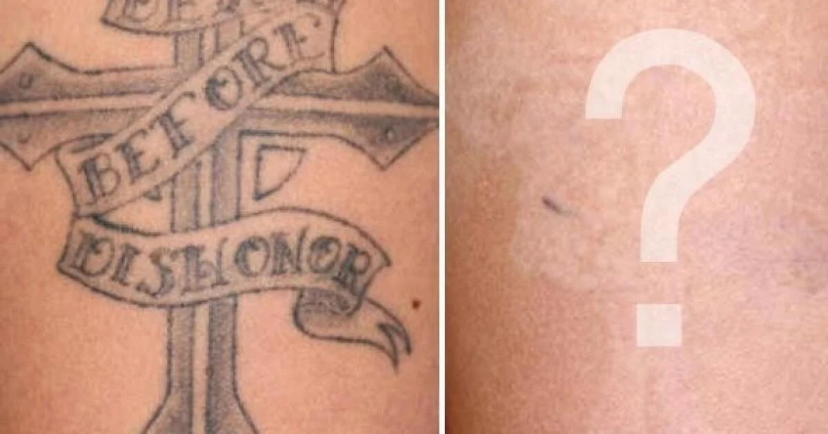 Before-and-After-Tattoo-Removal