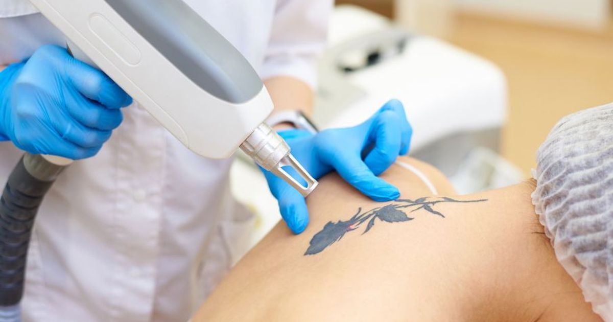 Laser-Light-Tattoo-Removal