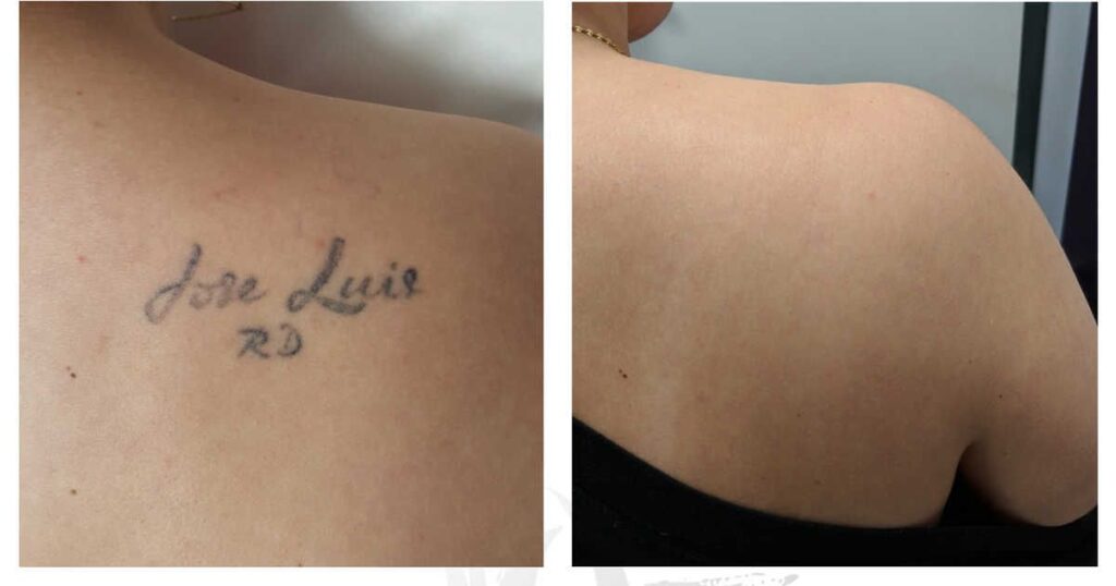 Laser-Tattoo-Removal-Before-And-After