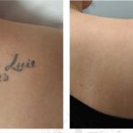 Laser-Tattoo-Removal-Before-And-After