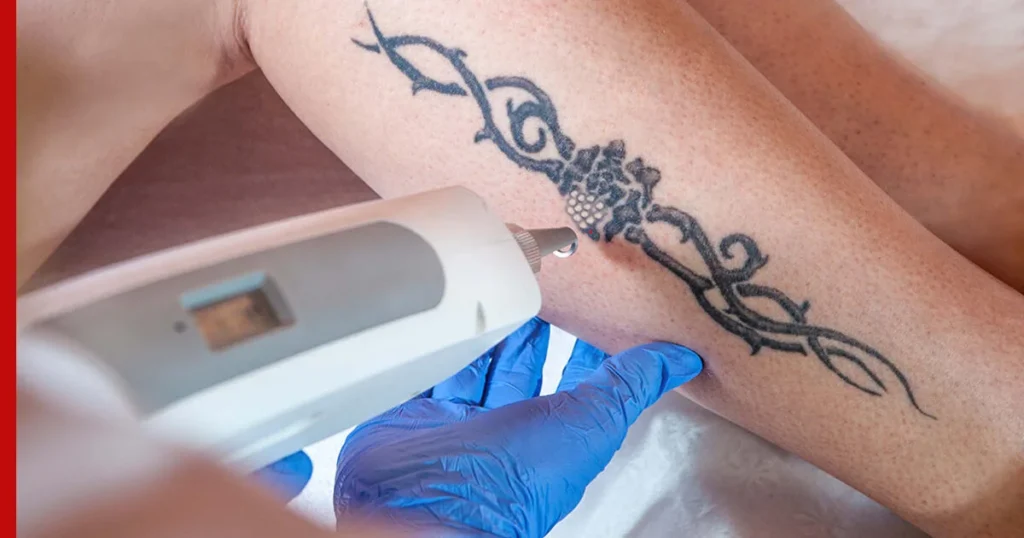 Laser-Tattoo-Removal-Price