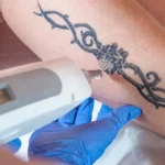 Laser-Tattoo-Removal-Price