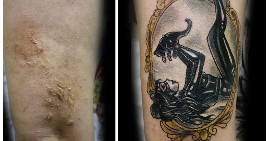 Dark-Tattoo-Removal-Before-And-After