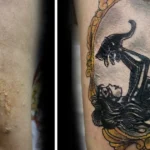 Dark-Tattoo-Removal-Before-And-After