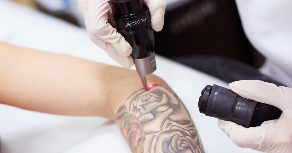 How-Does-Tattoo-Removal-Work