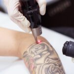 How-Does-Tattoo-Removal-Work