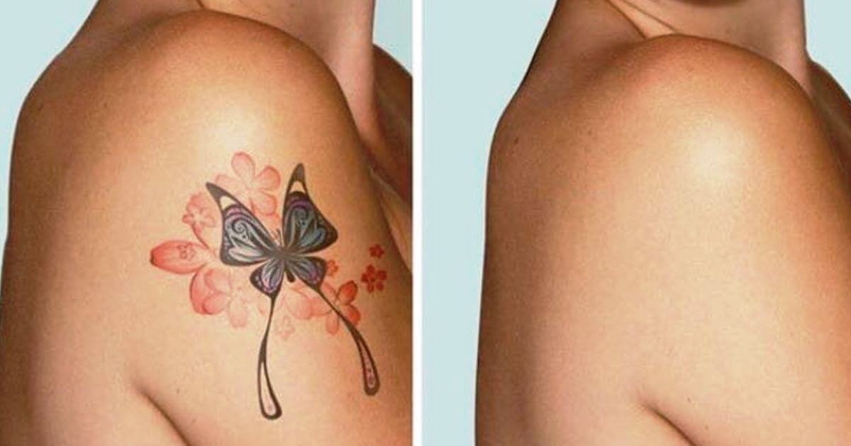 How-Much-Does-It-Cost-To-Remove-A-Tattoo