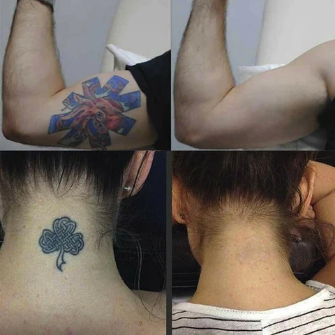 How-Much-Does-It-Cost-To-Remove-A-Tattoo