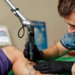 How-Much-Does-Tattoo-Removal-Cost