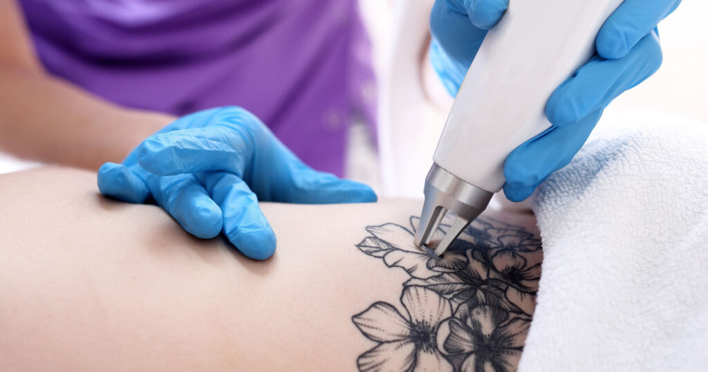 How-Much-Is-Laser-Tattoo-Removal