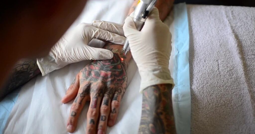 How-Much-Is-Tattoo-Removal-REALLY-Cost