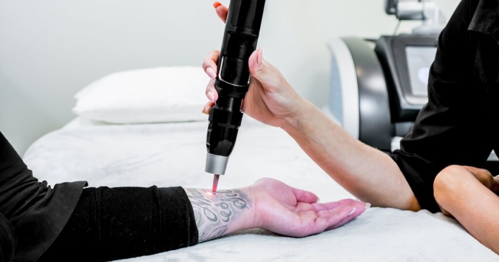 Laser-Light-Tattoo-Removal