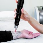 Laser-Light-Tattoo-Removal