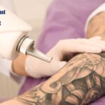 Laser-Treatment-for-Tattoo-Removal-Cost