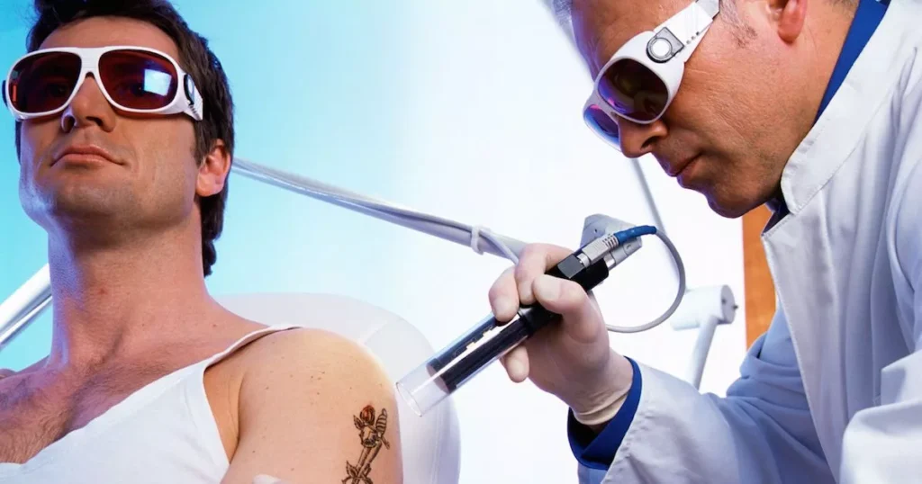 How-Much-Does-Laser-Tattoo-Removal-Cost