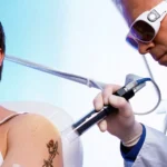 How-Much-Does-Laser-Tattoo-Removal-Cost