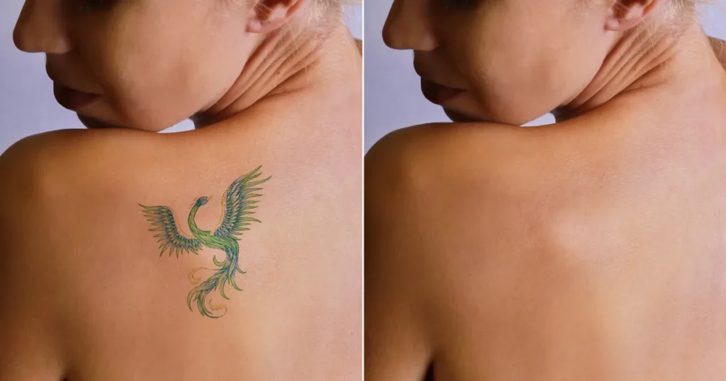 Tattoo-Cover-Ups-Generally-Cost-Less-Than-Multiple-Laser-Removal-Sessions