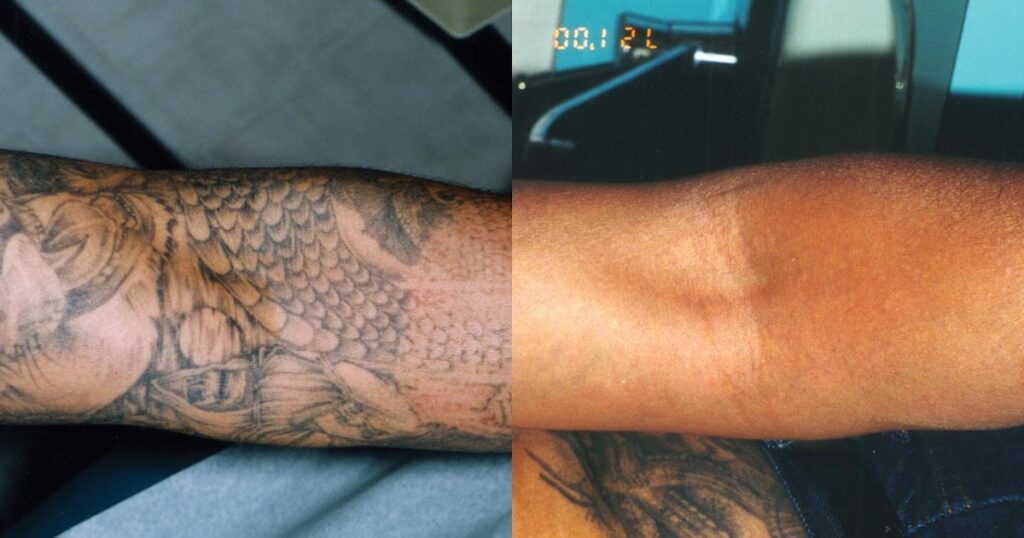 Tattoo-Laser-Removal-Before-and-After