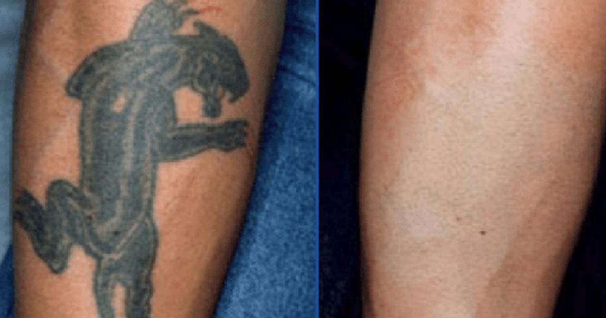 Tattoo-Removal-Before-and-After