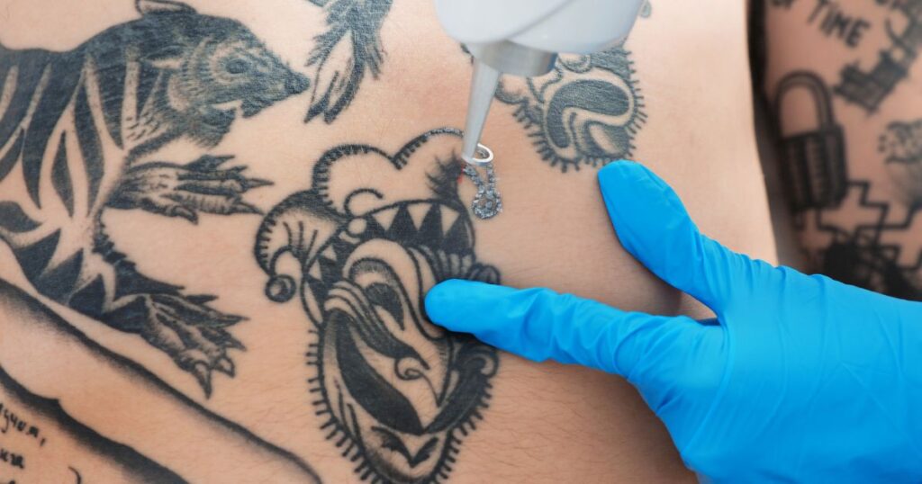 Tattoo-Removal-Charges