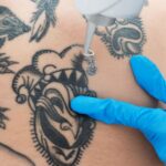 Tattoo-Removal-Charges