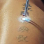 Tattoo-Removal-at-Home