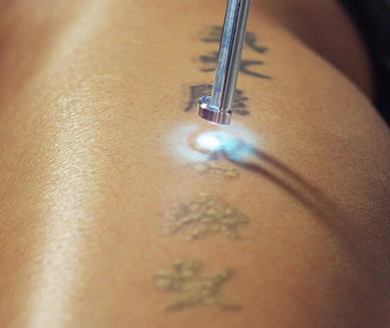 Tattoo-Removal-at-Home