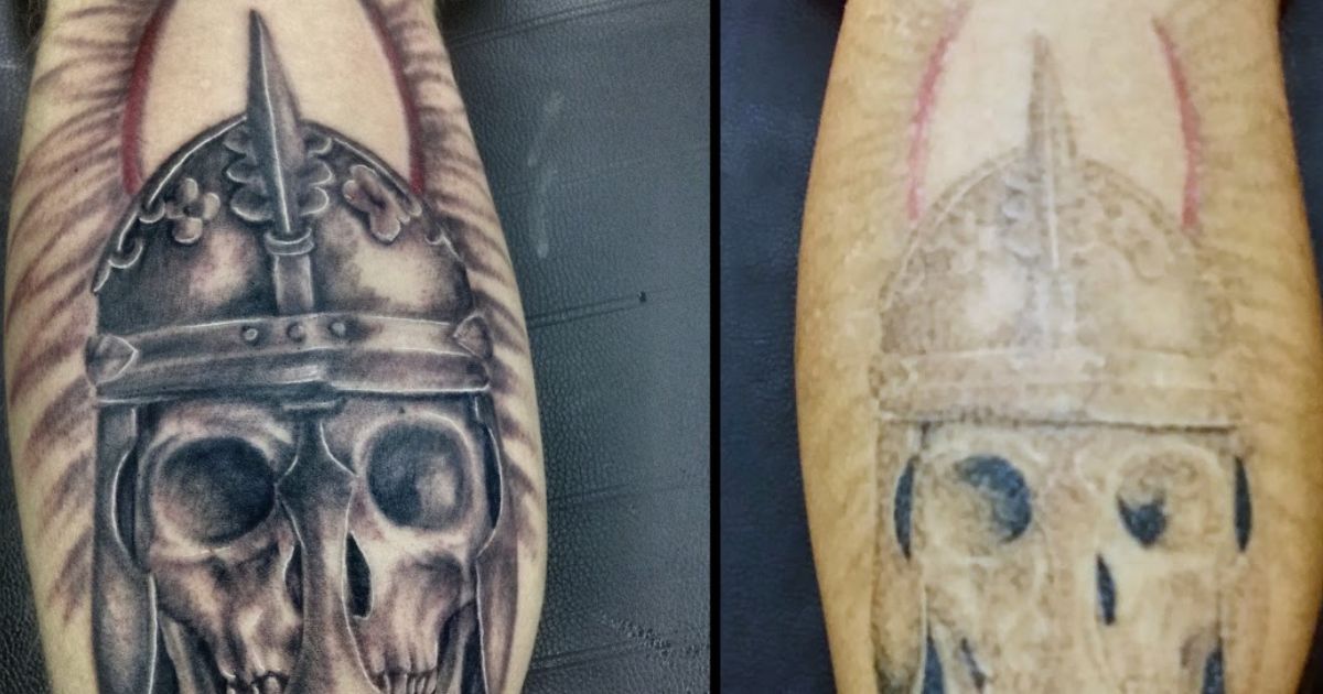 Before-and-After-Tattoo-Removal