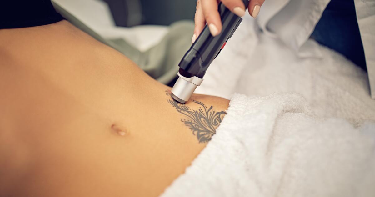 Laser-Tattoo-Removal-Price