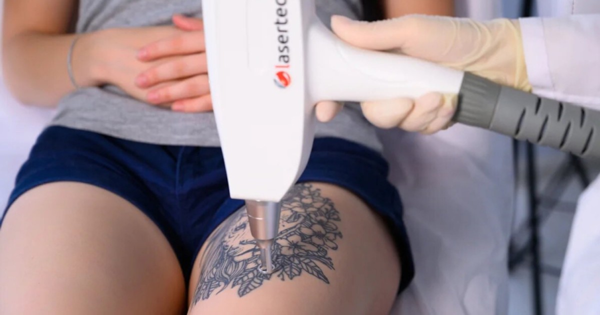 How-Much-Does-Laser-Tattoo-Removal-Cost