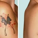 Tattoo-Removal-Before-and-After