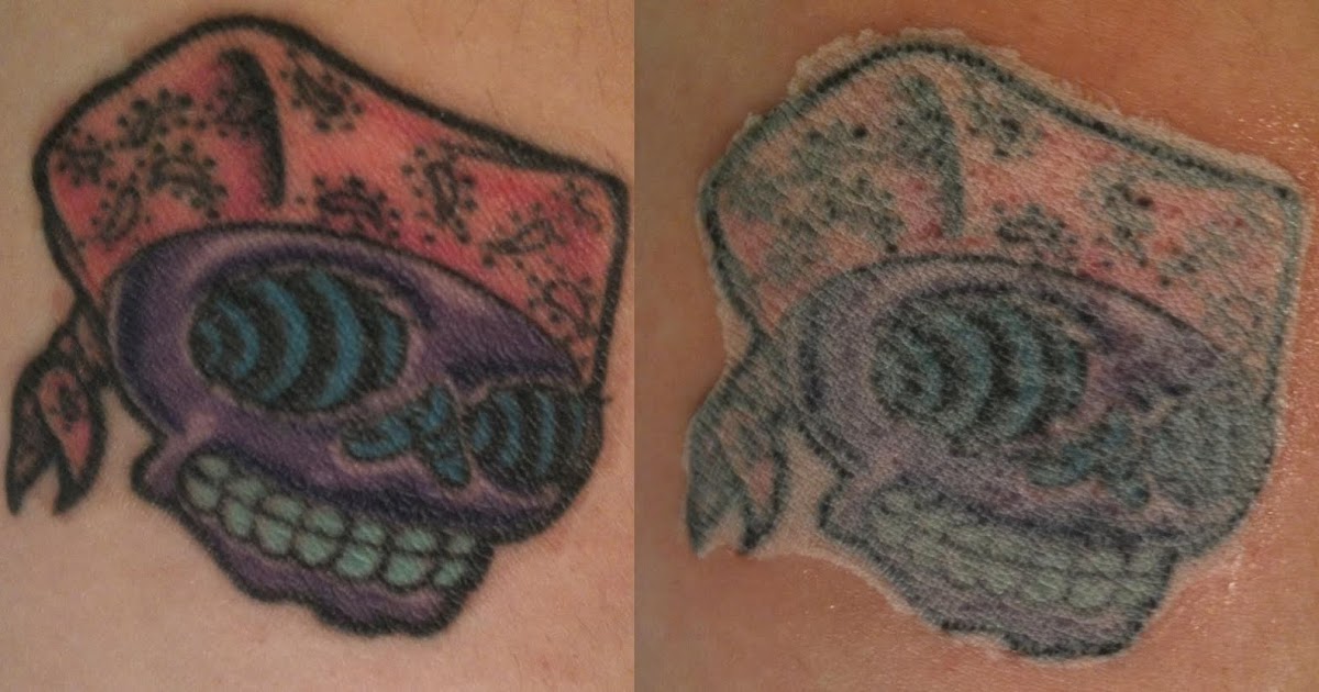 Tattoo-Removal-Before-and-After