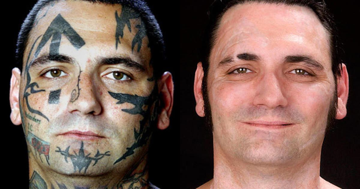 Laser-Tattoo-Removal-Before-And-After