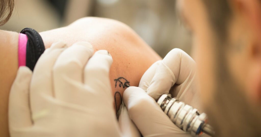 Tattoo-Removal-Charges