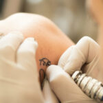 Tattoo-Removal-Charges