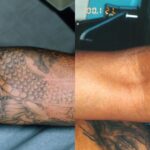 Before-and-After-Tattoo-Removal