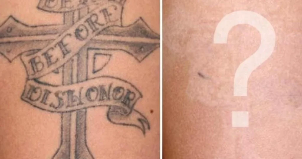 Dark-Tattoo-Removal-Before-And-After-Details