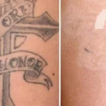 Dark-Tattoo-Removal-Before-And-After-Details