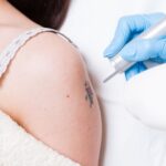 Is-Scarring-Common-After-Tattoo-Removal-Procedures?