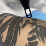 Does-Tattoo-Removal-Leave-Scars-and-How-Can-You-Avoid-Them?