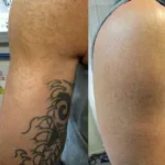 The-Dark-Tattoo-Removal-Before-and-After