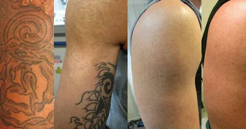 The-Dark-Tattoo-Removal-Before-and-After